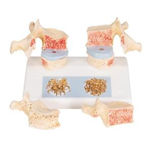 Osteoporosis Anatomical Model Ea