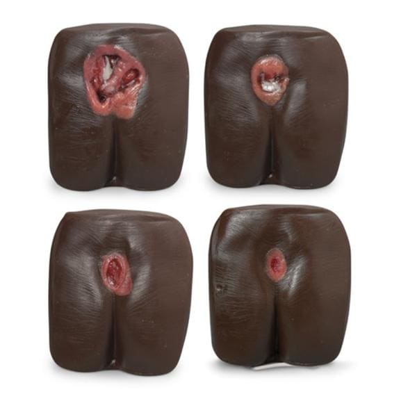Bed Sore/Pressure Ulcer Anatomical Model Ea