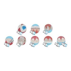 Mini-Mold Lingual Bite Ramp Tips Upper Anterior 8/Pk