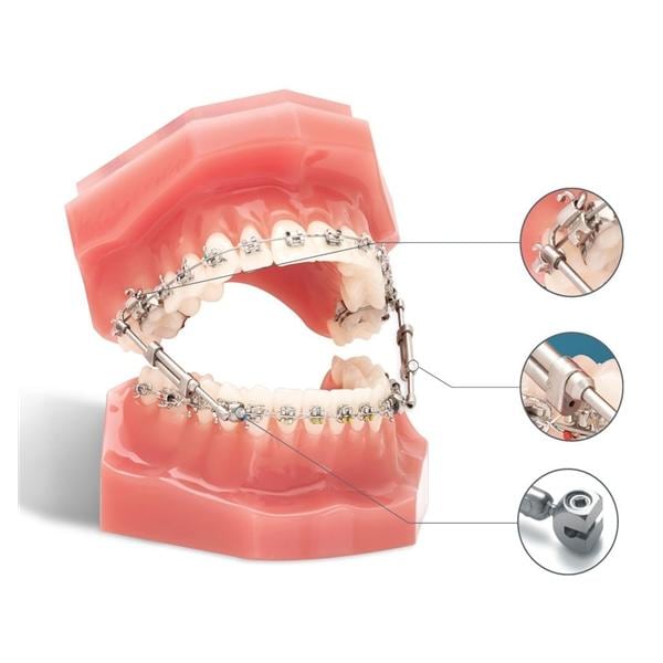TruEase Anchor Wire Bite Corrector 2/Pk