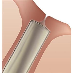 Intracanicular Patient Plug 0.3mm