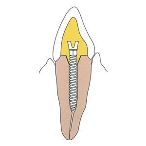 Surtex Posts Titanium 1.2 mm Parallel Sided & Tapered End 12/Bx
