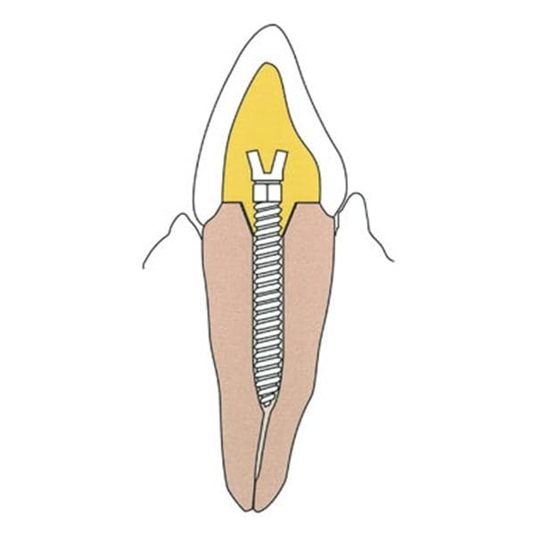 Surtex Posts Stainless Steel Size 1.2 mm Parallel Sided & Tapered End 12/Bx